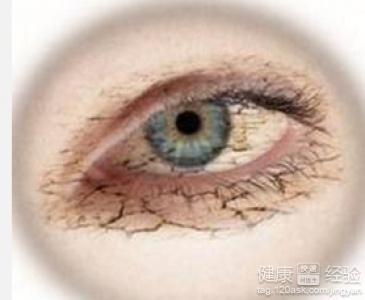 干眼癥怎樣能徹底治愈，全面理解與有效治療策略，全面理解與有效治療策略，干眼癥的根治之路