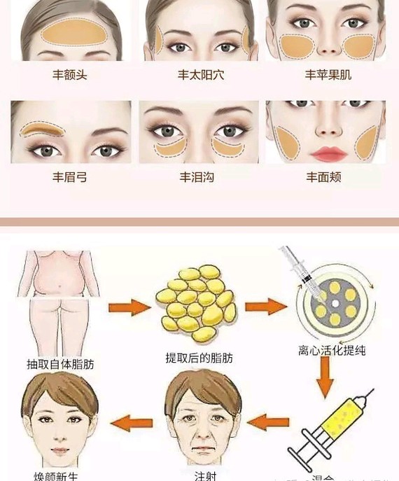 自體脂肪填充后最忌諱的幾個注意事項，自體脂肪填充后的關鍵注意事項與忌諱事項清單