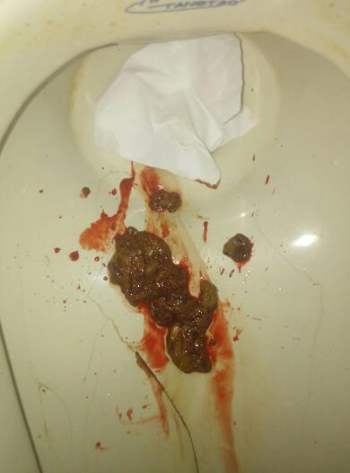 上大號拉出血怎么回事——解析便血的可能原因與應(yīng)對措施，解析，大便出血的原因及應(yīng)對措施