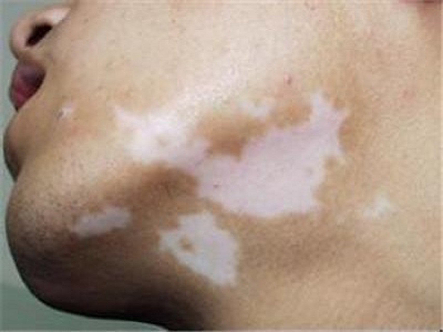 白點(diǎn)癲風(fēng)怎么治療效果最好，全面解析最佳治療方案，全面解析白點(diǎn)癲風(fēng)最佳治療方案，治療效果最大化